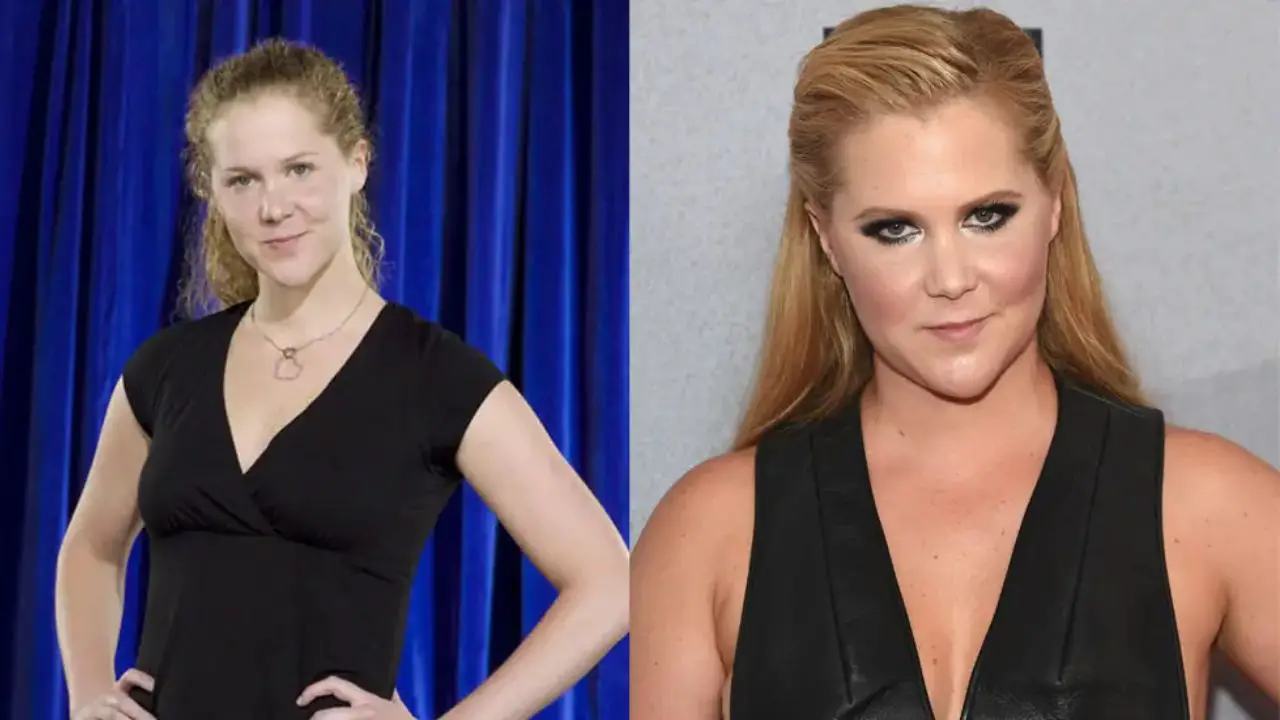 Amy Schumer’s 10-Pound Weight Gain Battle With Endometriosis