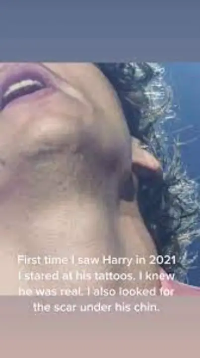 Harry Styles has a scar on his chin. netflixdeed.com
