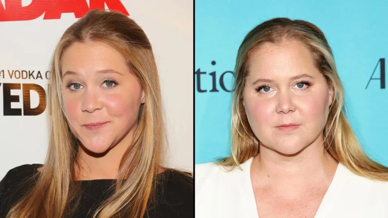 Amy Schumer has had a weight gain of 10 pounds because of endometriosis.